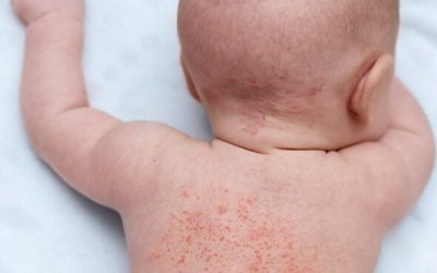 Brotoejas x alergia ao suor: conheça a diferença