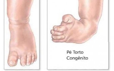 Coisas de bebê: pé torto congênito