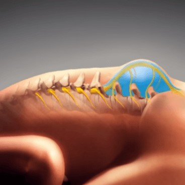 Tudo que você precisa saber sobre espinha bífida