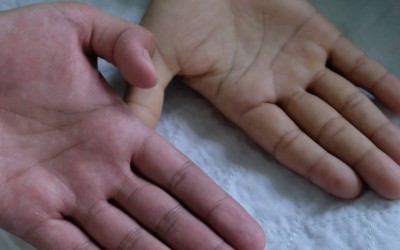 Você sabe o que é anemia falciforme? Aprenda aqui!