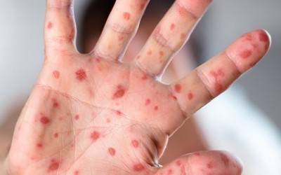 Síndrome mão-pé-boca: entenda tudo sobre a doença!