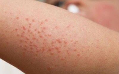 Seu filho tem alergia? Veja os sintomas da dermatite atópica!