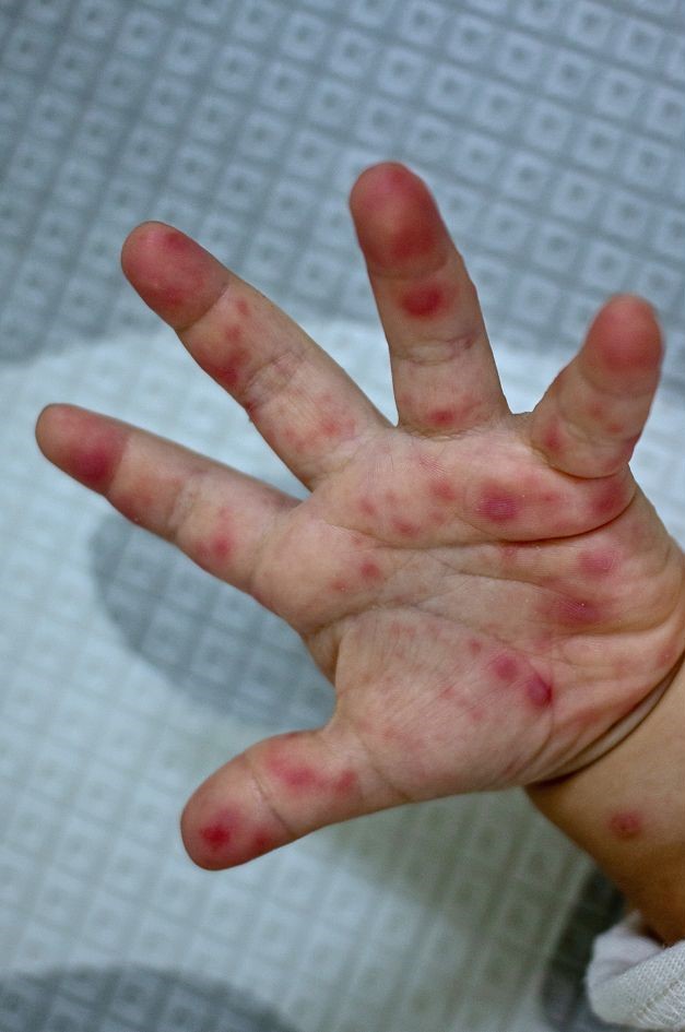 Doença mão pé boca: transmissão, sintomas e tratamento! - Noeh