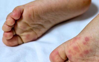 Doença mão pé boca: transmissão, sintomas e tratamento!